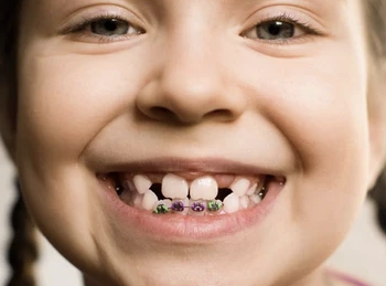 El Centre Dental Francesc Macià explica en qué consiste un tratamiento de ortodoncia infantil y sus posteriores beneficios